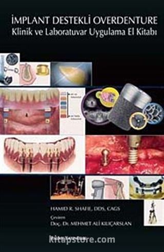 İmplant Destekli Overdenture