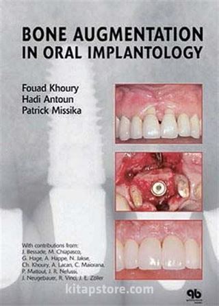 Bone Augmentation ın Oral Implantology (Oral İmplantolojide Kemik Agumentasyonu)