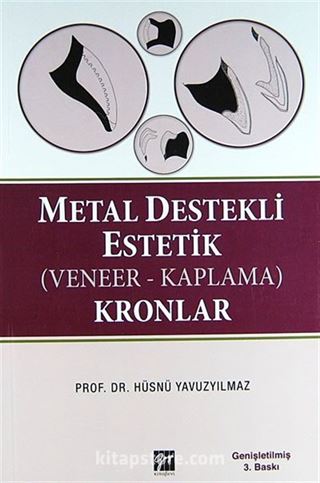 Metal Destekli Estetik (Veneer-Kaplama) Kronlar