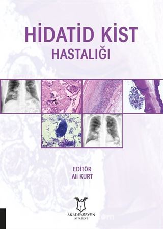 Hidatid Kist Hastalığı