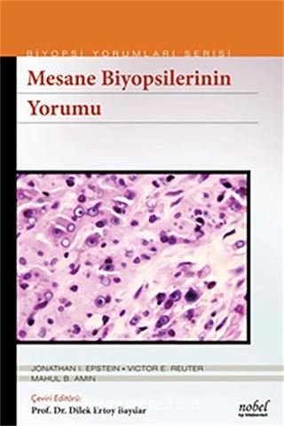 Mesane Biyopsilerinin Yorumu - Biyopsi Yorumları Serisi